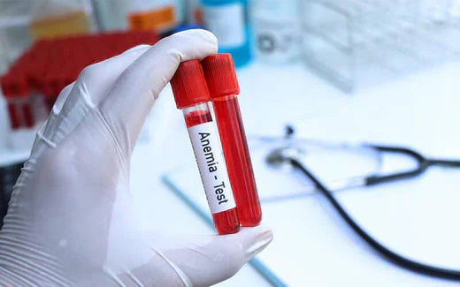 Diagnóstico de anemia: uma condição bastante comum 