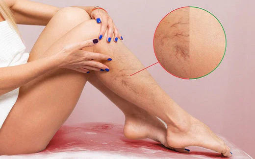 Veias de aranha, como saber se corro o risco de desenvolvê-las? 